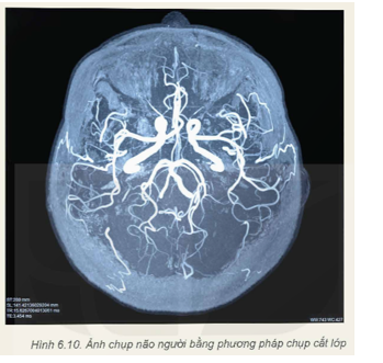 1. Giải thích lí do tại sao bệnh nhân có thể được yêu cầu nín thở trong khi chụp cắt lớp.

2. Giải thích lí do tại sao khi chụp não thì chụp cắt lớp lại