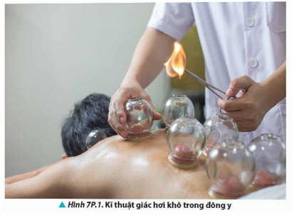 Giác hơi là một kĩ thuật chữa bệnh trong đông y để điều trị các bệnh do nguyên nhân hàn (lạnh) gây ra như: đau bụng, lưng, vai, gáy, cổ,  (ảnh 1)