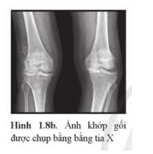 Giải thích vì sao có vùng màu sẵm, vùng màu sáng ở ảnh chụp khớp gối bằng tia X trong Hình 1.8b.